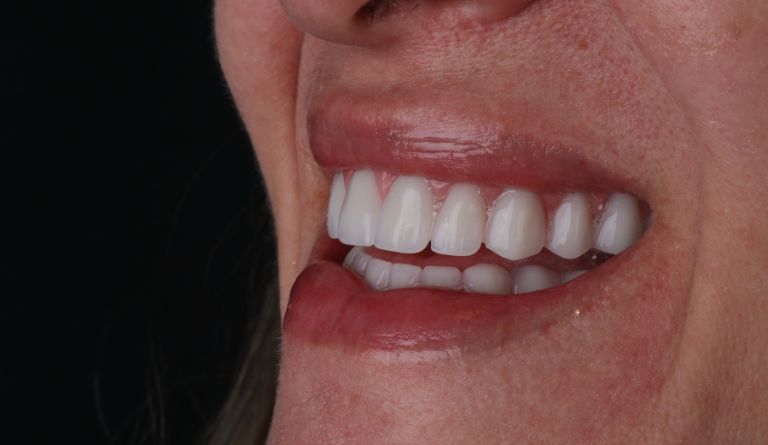 Implante dentário dói Descubra a verdade sobre as novas tecnologias em Brusque