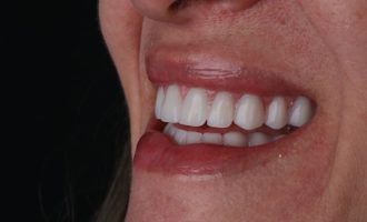 Implante dentário dói Descubra a verdade sobre as novas tecnologias em Brusque